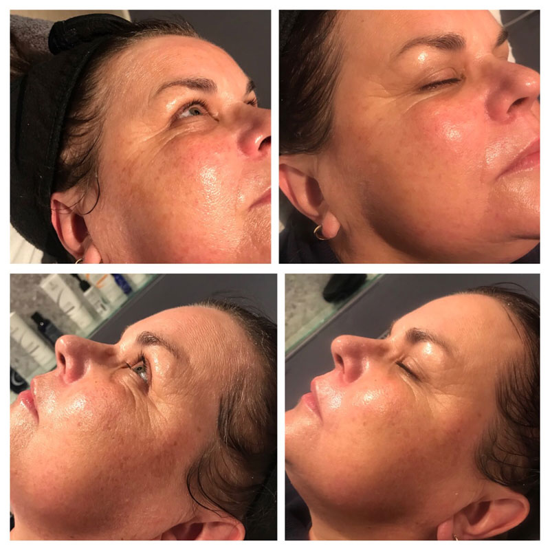 Resurfacing Peels Before and After image
