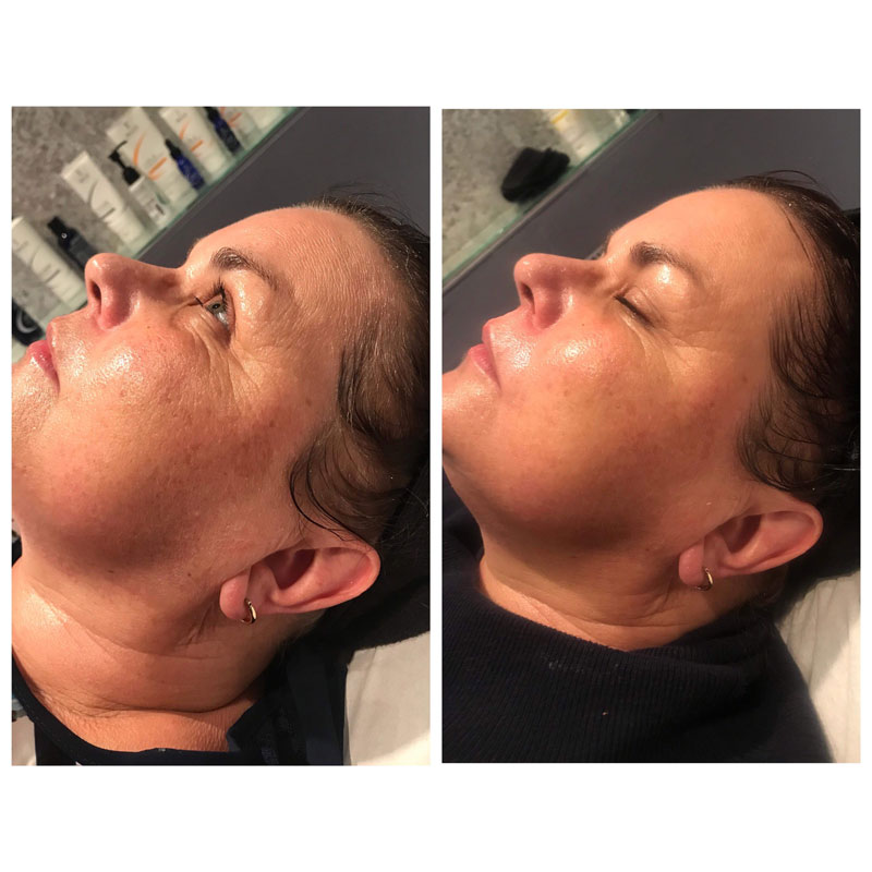 Signature Peel Before and After image