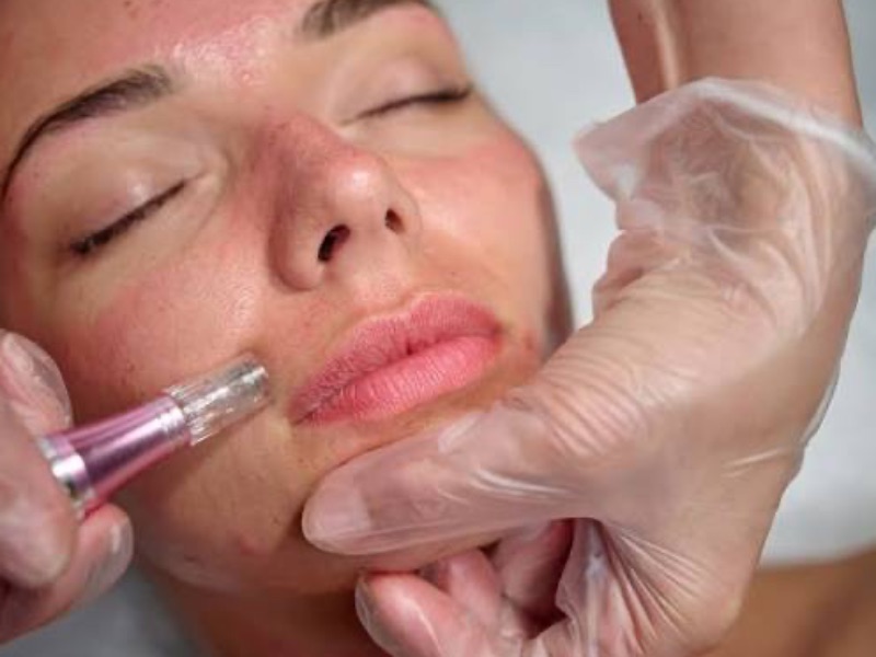 Microneedling
